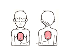 PHILIPS HeartStart HS1 Elektroder Barn